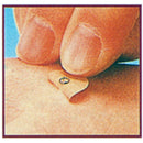Nihon Yakuko Hi-Acupuncture needle 30 needles